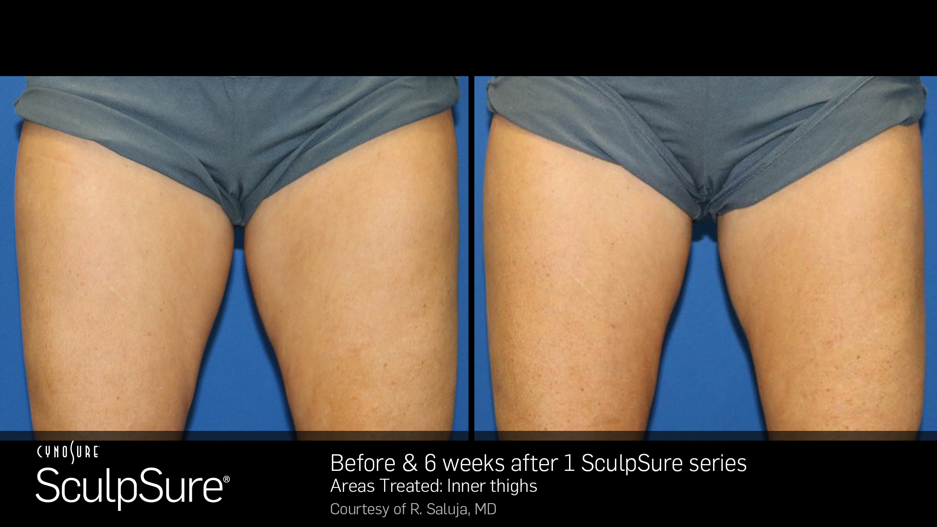 SculpSure Example - Inner Thighs