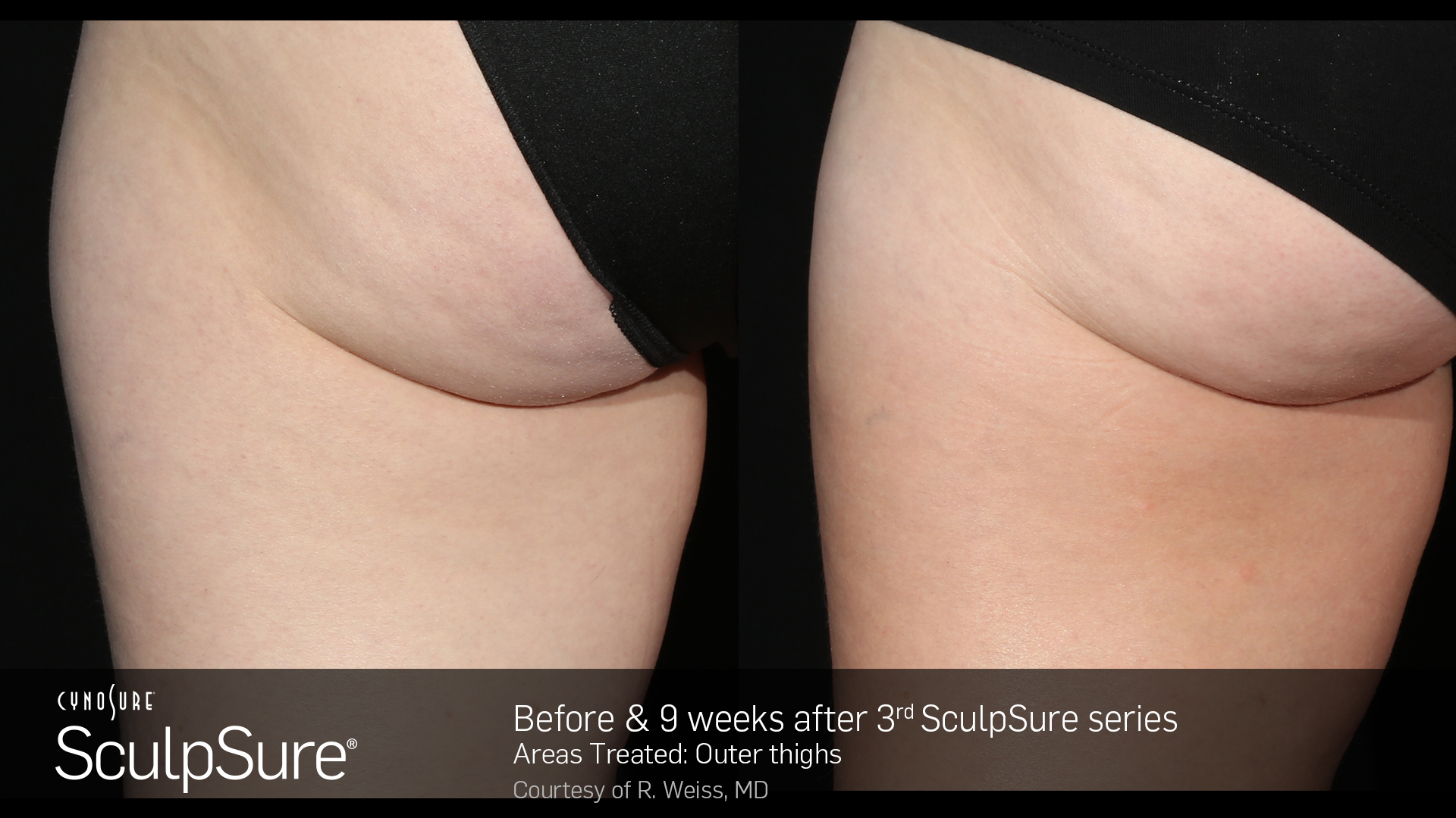SculpSure Example - Outer Thighs