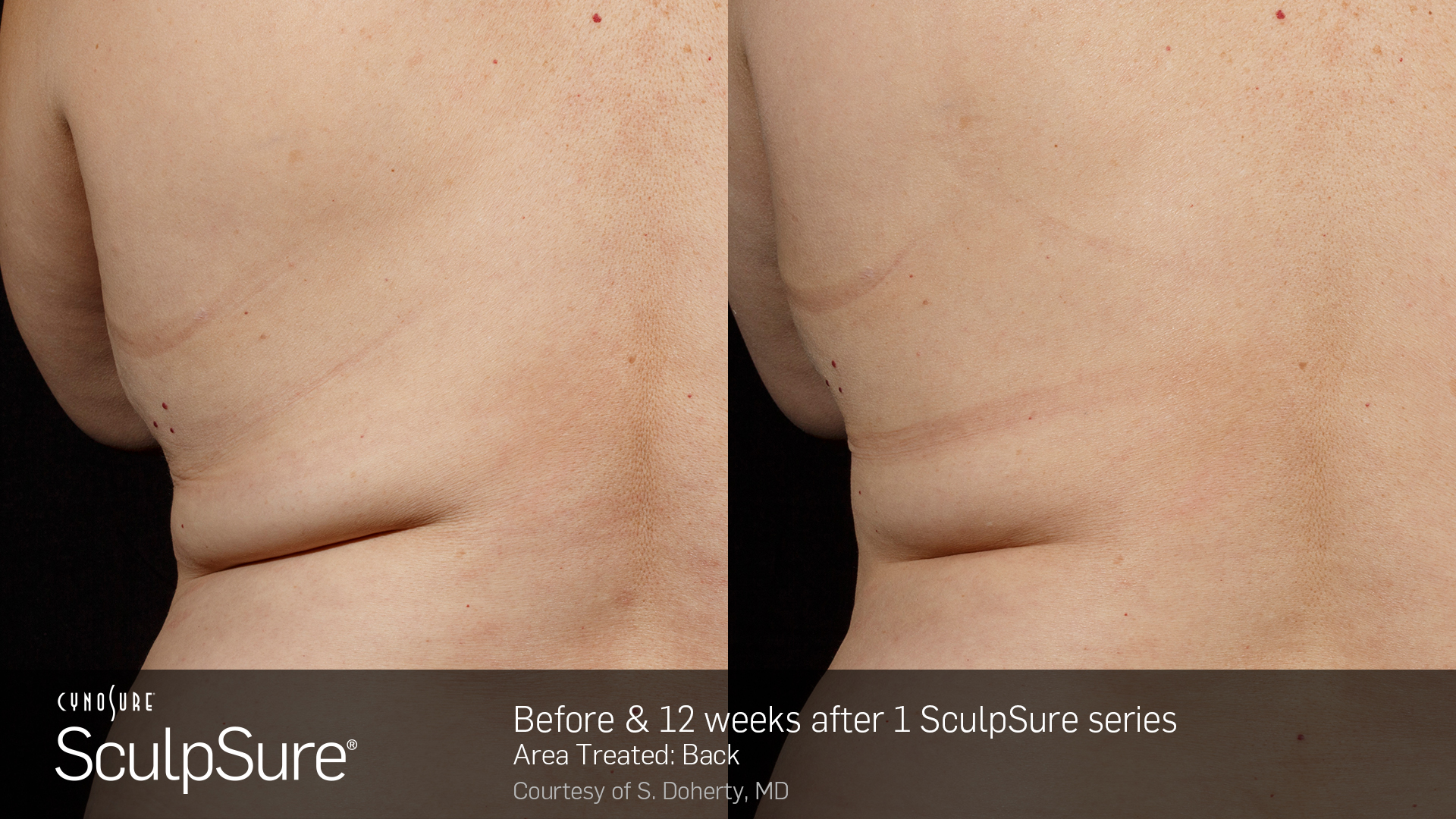 SculpSure Example - Back
